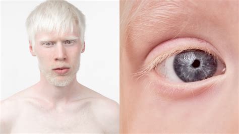 uomo albino|Albinismus • Merkmale und Ursachen [mit Video]